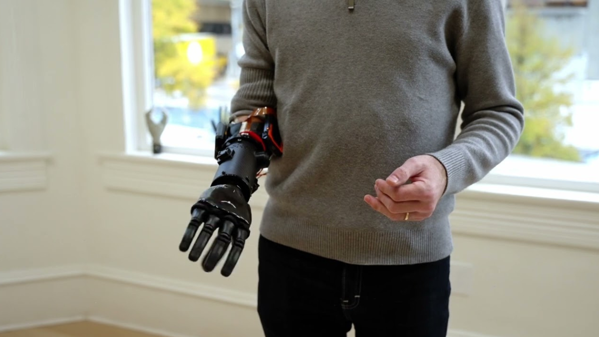 Person demonstrating advanced bionic prosthetic arm with neural-controlled hand